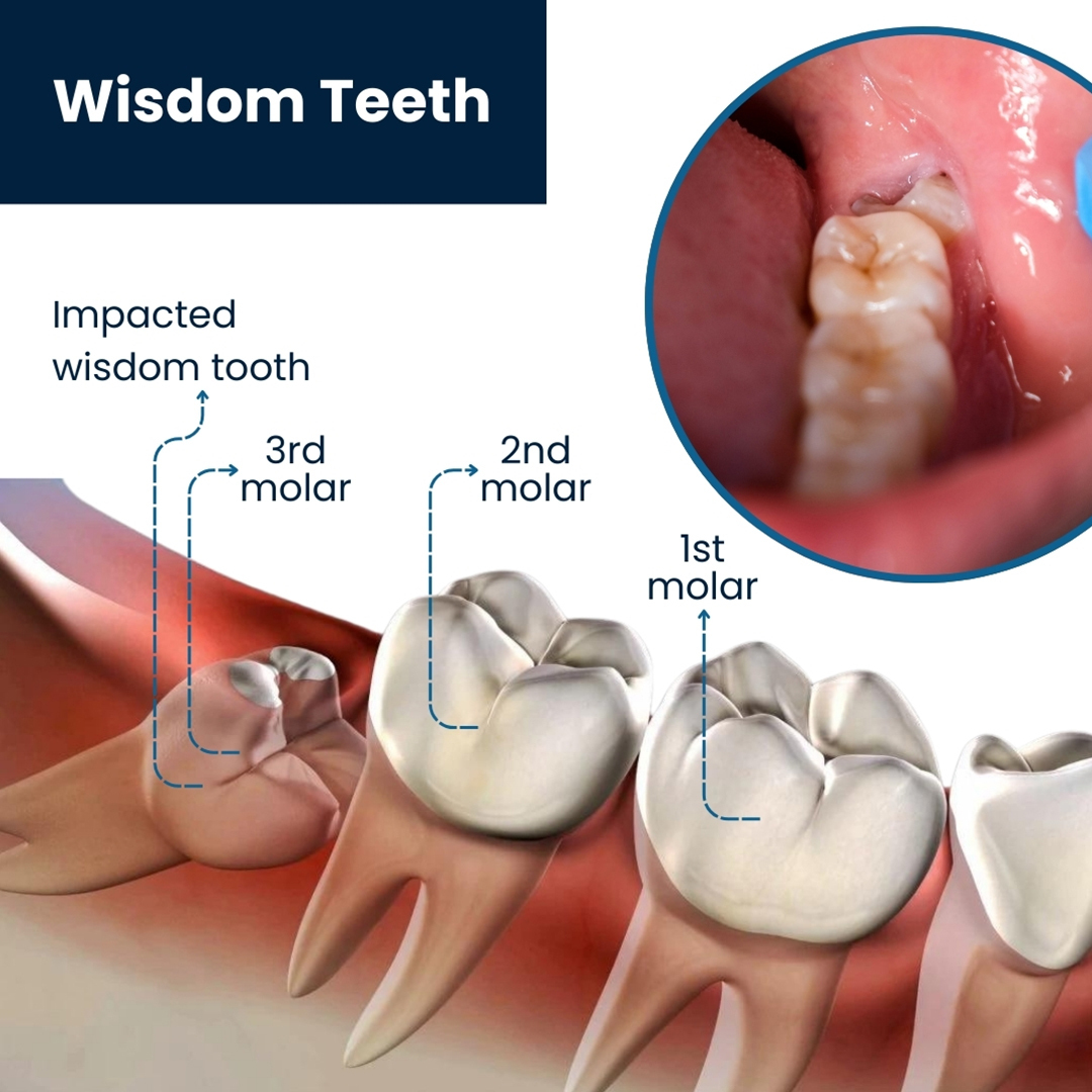 Wisdom Teeth Removal